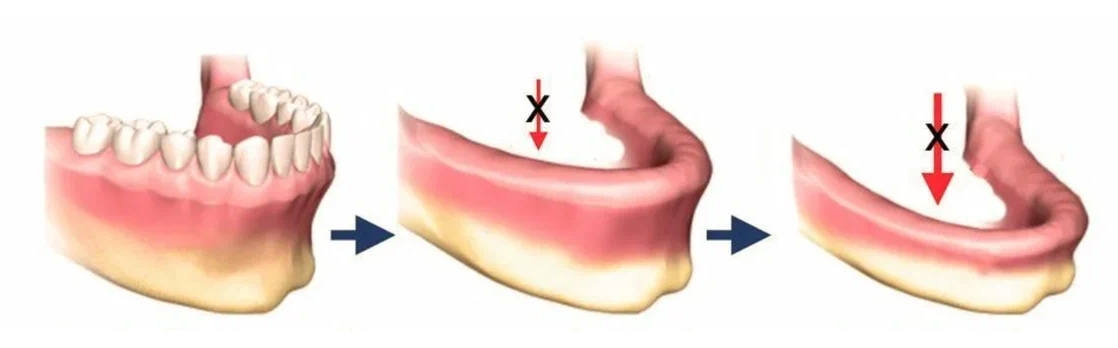 атрофия кости при установки зубного моста