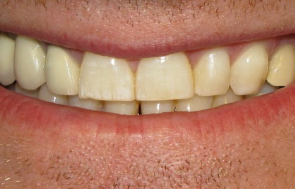 пятна флюороза на зубах с признаками стираемости