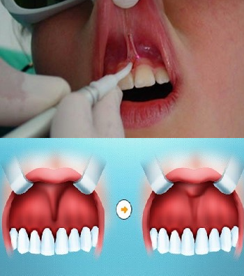 Френулопластика в стоматологии