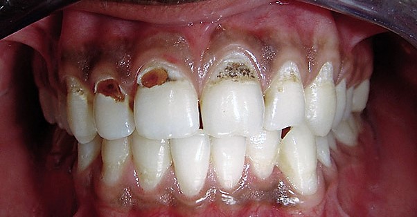 Глубокий кариес на передних зубах