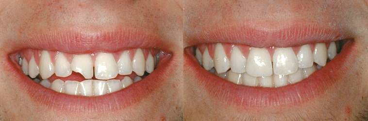 Художественная реставрация зубов: фото до и после