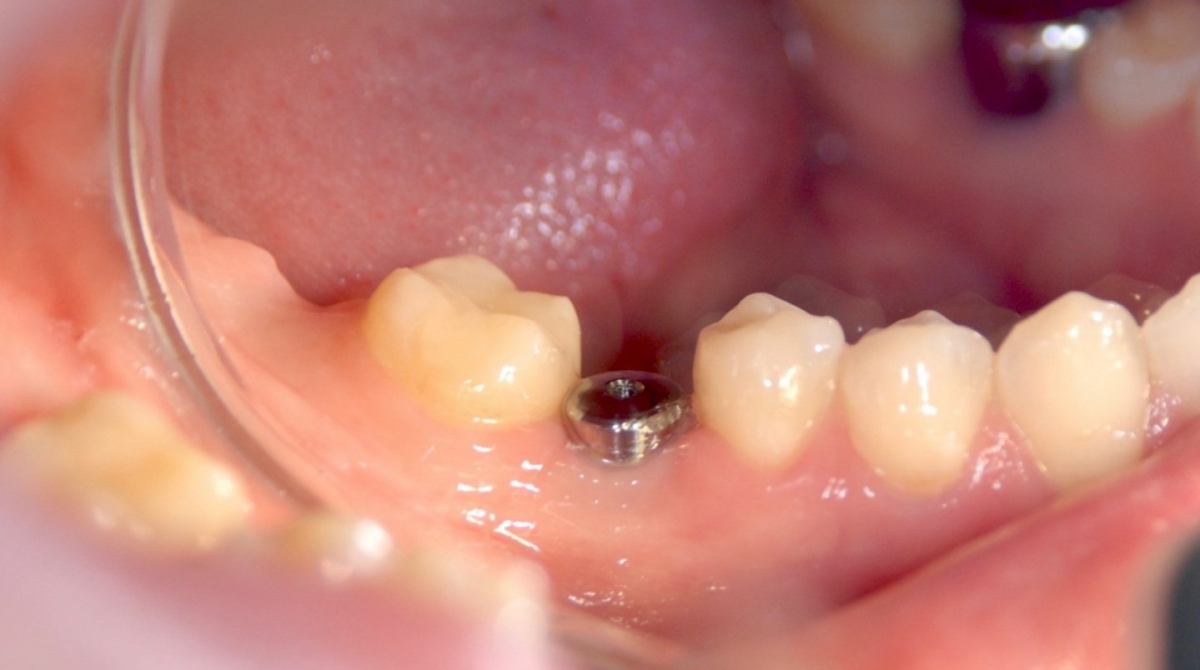 Имплантация зубов: установка формирователя десны