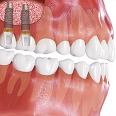Имплантация зуба после костной пластики