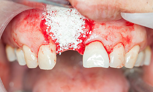Костная пластика при имплантации зубов, осложнения