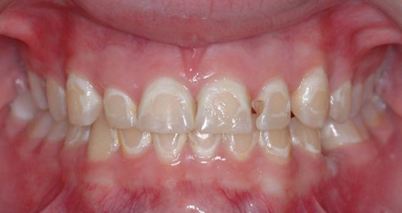 Очаговая деминерализация зубов