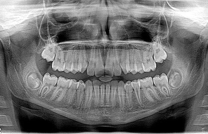 обзорный снимок всех  зубов верхней и нижней челюсти