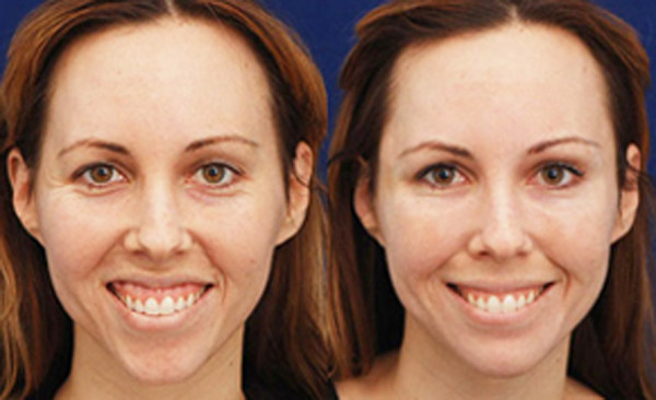 Пластика уздечки верхней губы: фото до и после