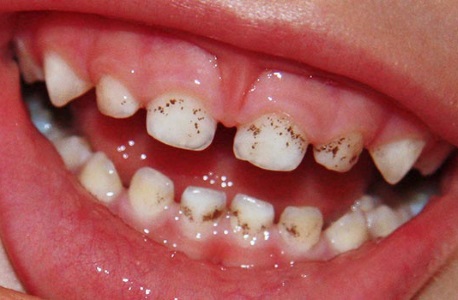 Пятна на молочных зубах