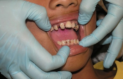 Лечение зубов ребёнка