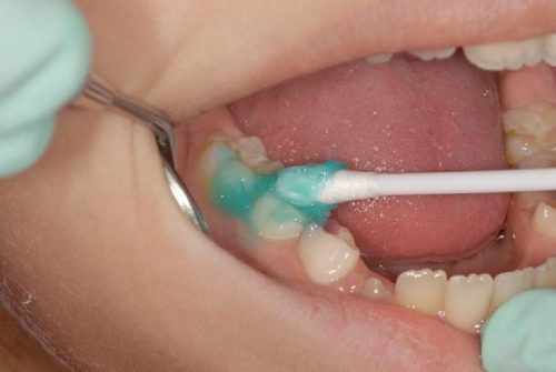 Реминерализация молочных зубов