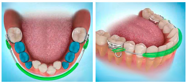 Съемный ортодонтический аппарат губной бампер