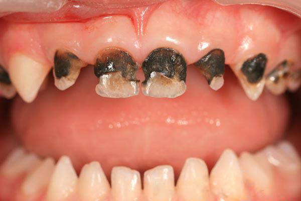 Сильный кариес молочных зубов