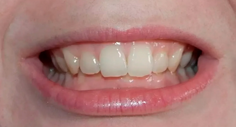 перекрытие зубов