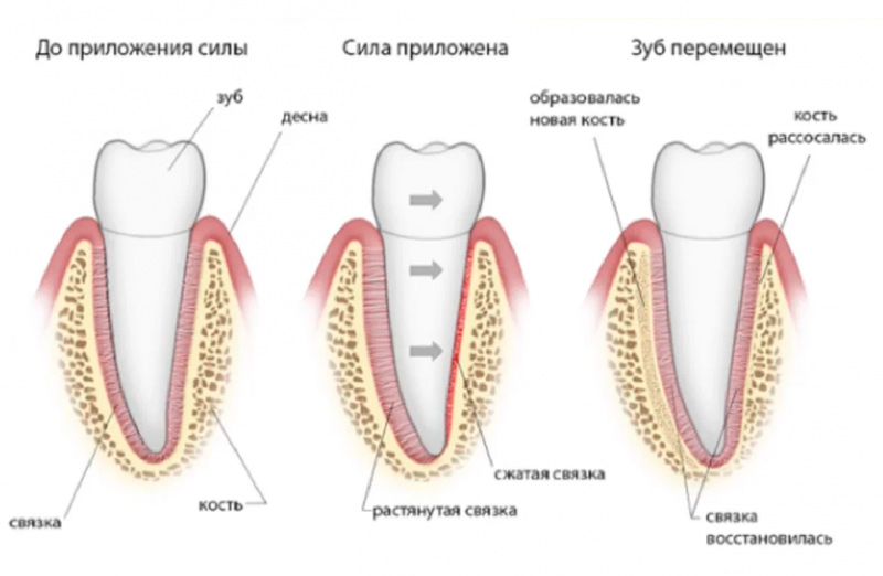 процесс движения зубов