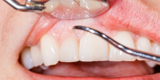 Деминерализация эмали зубов у взрослых и детей