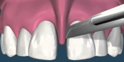 Пластика уздечки верхней губы в стоматологии
