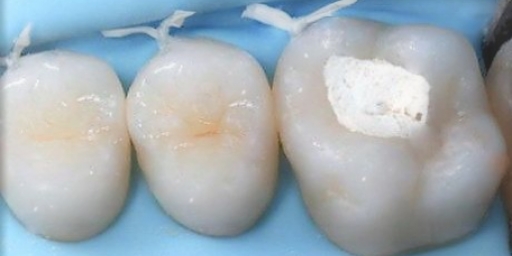 Пломбирование зуба временной пломбой