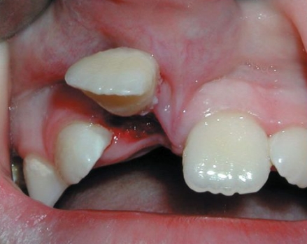 Травма переднего зуба