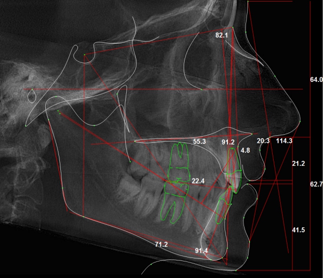 ТРГ снимок зубов в боковой проекции