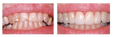 Виниры на кривой зуб до и после