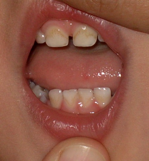 Желтые зубы у ребенка