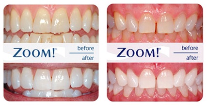 До и после отбеливания зубов системой ZOOM
