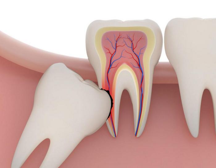 удаление восьмых зубов